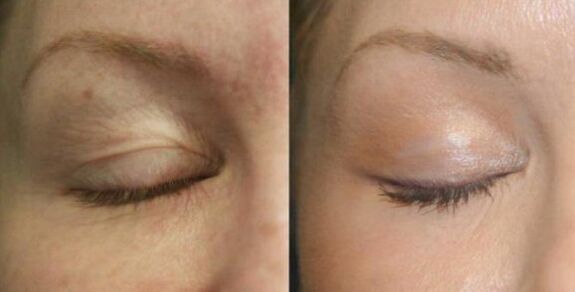 Take care of an area near the eyes
