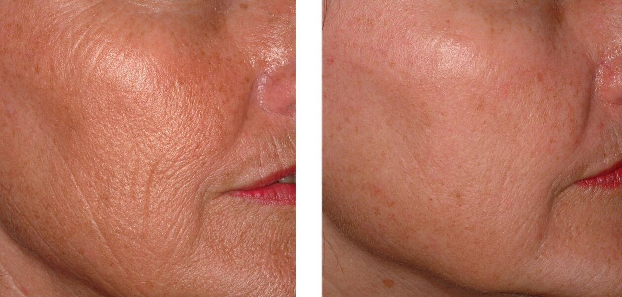 The renewal of the skin