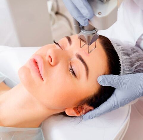Laser renewal of the face