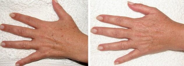 Effectiveness of removing pigment spots on hands