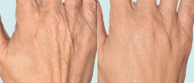Hand skin before and after fracture treatment