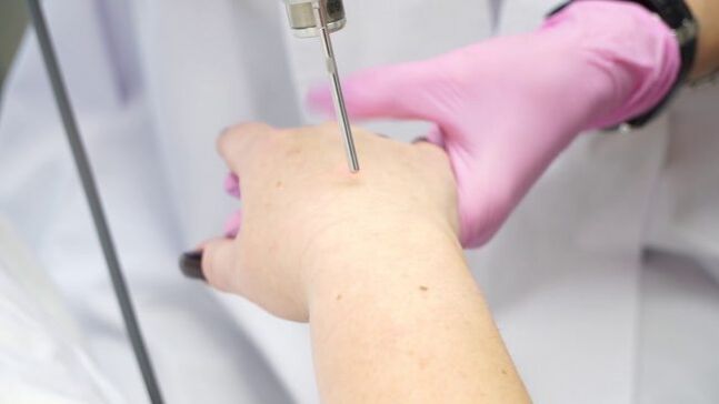 Laser skin rejuvenation