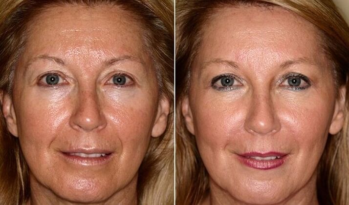before and after skin rejuvenation
