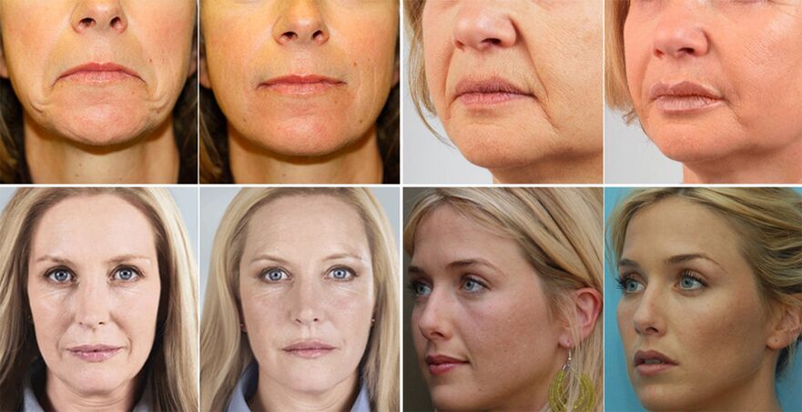 pictures of women before and after facial rejuvenation