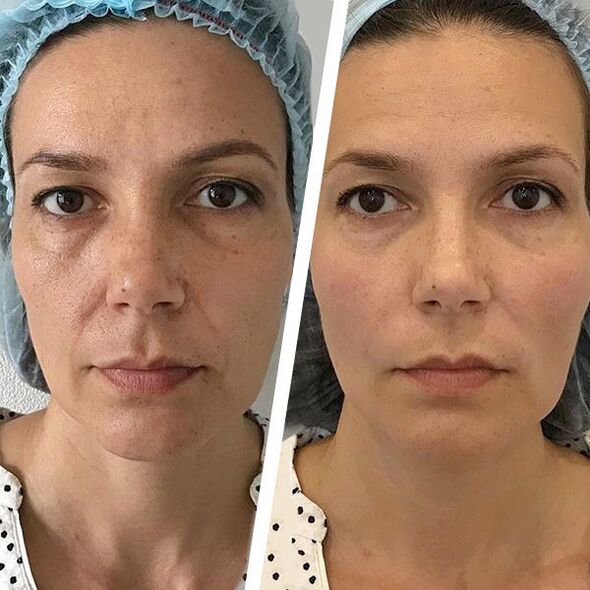portrait before and after laser rejuvenation